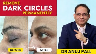 Get Rid of Dark Circles Permanently  ATHENA 360° Eye Laser™ Treatment by Dr Anuj Pall [upl. by Lukin]