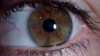 Nistagmus rotatorio  Rotary Nystagmus [upl. by Everson]