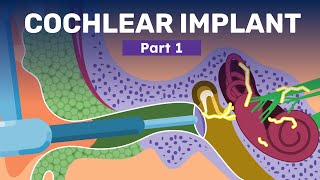 What is A Cochlear Implant  How Hearing Aids and Implants Help Recover Hearing Loss [upl. by Lisle188]