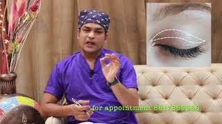 ptosis surgery झुकी हुई पलकों की सर्जरी ptosis treatment in Bhopal [upl. by Cavit917]