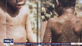 Monkeypox virus spreading worldwide 80 cases in 11 countries [upl. by Dreda]