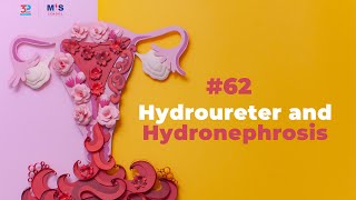 Hydroureter and Hydronephrosis [upl. by Doug]