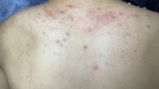 ACNE TREATMENT VU QUYNH MI  Acne On Back FULL [upl. by Godliman]