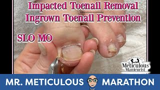 How to Clean Impacted Toenails to Prevent Ingrown Toenails MrMeticulousMarathon [upl. by Herzog369]