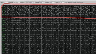 Temporal Lobe Seizure in Sleep [upl. by Bailar]