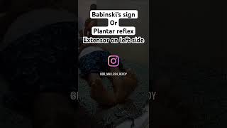 Babinski’s sign or Plantar reflex babinski’s sign plantarreflex neurology reflexes [upl. by Irek]