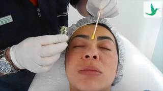 Peeling Ácido Retinoico  Marco Martínez Estética [upl. by Ojytteb549]