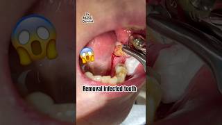 Removal of Infected Tooth [upl. by Ardiekal259]