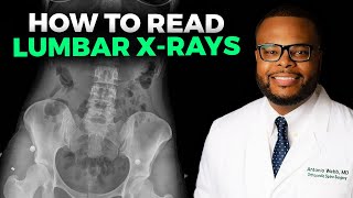 How to Read a Lumbar XRay [upl. by Ramsa]