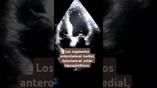 Hipoquinesia anterolateral medial y apical echocardiogram hipoquinesia akinesia infarto [upl. by Greenes]