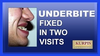 Fix Underbite Without Orthognathic Surgery [upl. by Premer]