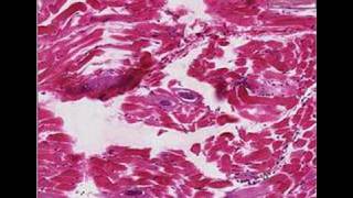 Histopathology Skeletal muscle Trichinosis [upl. by Kacerek]