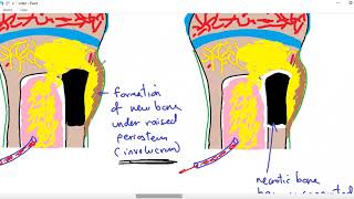 Systemic pathology 34  bone 4  osteomyelitis  DRSAMEH GHAZY [upl. by Asin6]