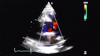 Aortenklappe in PSAX mit Farbdoppler aortic valve in PSAXview with color doppler [upl. by Rik]