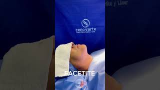 FACETITE perfilado facial y lipo de papada 📲 Te esperamos en valoración 3107637062 [upl. by Nerrej]