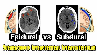 Epidural Subdural Subarachnoid Intracerebral Intraventricular Hematoma Hemorrhage [upl. by Ellitnahc422]