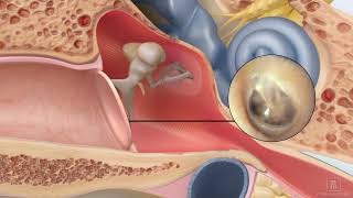 Repair a perforated ear drum using ClearDrum [upl. by Mikkanen]