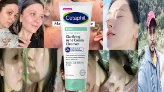 Cetaphil Clarifying Acne Cream Cleanser  Honest Review [upl. by Ahsrav]