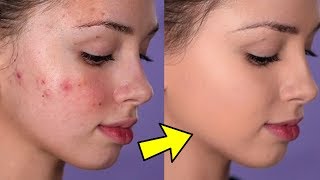 How To Cover Acne and Blemishes  EASY amp NONCAKEY [upl. by Erl485]