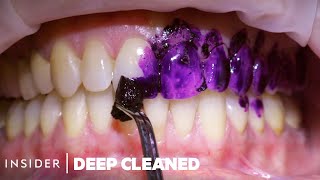 How Teeth Are Professionally Deep Cleaned  Deep Cleaned [upl. by Ecneitap]