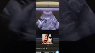 Ectopia Cordis fetal ultrasound by DrHaissam Aref DMS MSc MDUltrasound [upl. by Retsek]