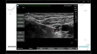 Behind the Scan Webinar Ultrasound Guided Adductor Canal and iPACK Blocks for Knee Surgery [upl. by Wolf697]