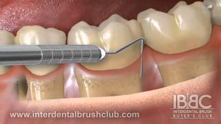 Periodontal disease causes and treatment [upl. by Vacuva]