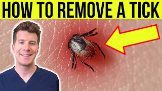 Doctor explains HOW TO REMOVE A TICK  Stepbystep guide [upl. by Pillow]