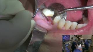 Extraction and Premolar Implant Placement [upl. by Neelia]