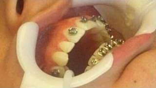 Orthodontist Places Braces on PatientSee how easy it is to get braces [upl. by Tryck473]