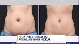 CoolSculpting Treatment on News 12 Connecticut with Before and Afters [upl. by Nwahsed817]