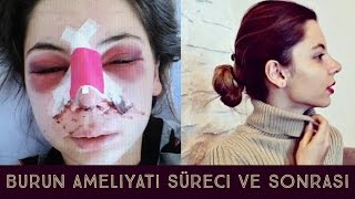 BURUN AMELİYATI HAKKINDA  Ameliyat süreci Tamponların çıkarılması Ücreti Morluk ve şişler [upl. by Dadelos720]