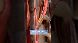 How carotid stenting prevents stroke a stepbystep guide to restoring blood flow [upl. by Oiluig745]