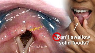 Cricopharyngeal Dysfunction Difficulty Swallowing Especially Solid Foods [upl. by Anirtik]