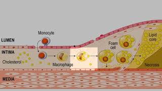 LDL CHOLESTEROL FOAM CELLS PLAQUE ATHEROSCLEROSIS EXPLAINED [upl. by Mastrianni219]