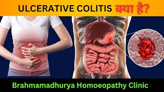 quotUlcerative Colitis Understanding Homeopathic Treatments and Effective Managementquot [upl. by Ahsaenat]