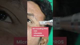 Microneedling Procedure at VCare  Best Treatment For Acne Acne Scars Wrinkles amp Fine Lines [upl. by Jona663]