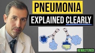 Pneumonia Explained Symptoms Diagnosis Labs Treatment [upl. by Atteuqahs]