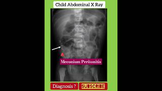 Meconium peritonitis  Diagnosis   Abdominal X RAY  RADIOLOGY [upl. by Nodanrb53]