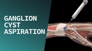 Ganglion Cyst Aspiration [upl. by Ahs637]