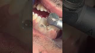 Deep cervical caries dentist dental teeth dentista dentist dentition [upl. by Netsua]