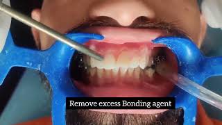 Orthodontic Bonding Procedure [upl. by Bogosian172]