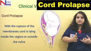 Cord Prolapse  Definition Risk factors Diagnosis  Nursing Lecture [upl. by Elram499]