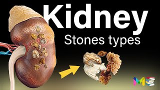 TYPES OF KIDNEY STONES [upl. by Marlon525]