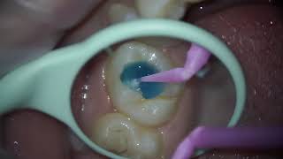 Secrets to Perfect Molar Tooth Treatment dentist teeth dentistry dental cavity tooth [upl. by Warfore]