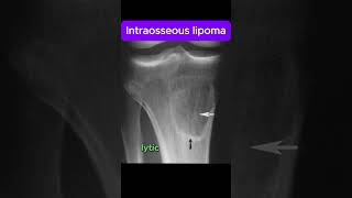 Intraosseous Lipoma [upl. by Carmon]