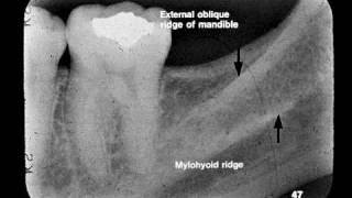 Dental Radiographic Anatomy [upl. by Noryahs801]