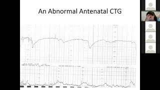 What is Cardiotocography   Gynaecology Lecture  MBBS Lecture MBBS [upl. by Epperson]