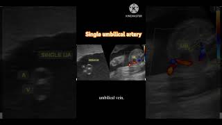 Single umbilical arterywhat is it sua [upl. by Gottfried]