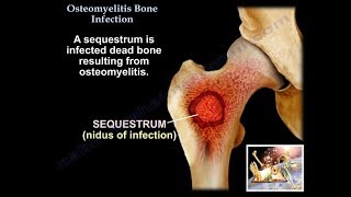 Osteomyelitis Bone Infection  Everything You Need To Know  Dr Nabil Ebraheim [upl. by Powder503]